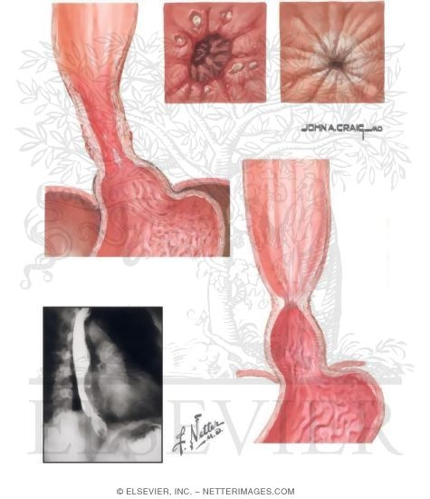 Gastroesophageal Reflux Disease