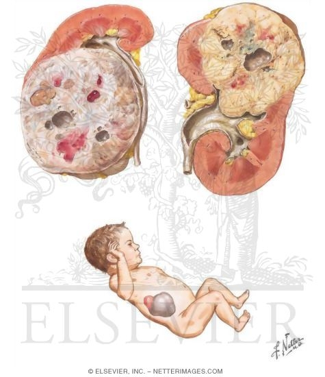 Malignant Tumors of the Kidney