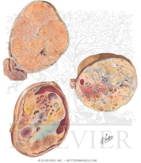 Testicular Cancer