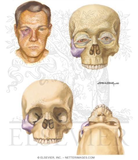Fractured Zygoma