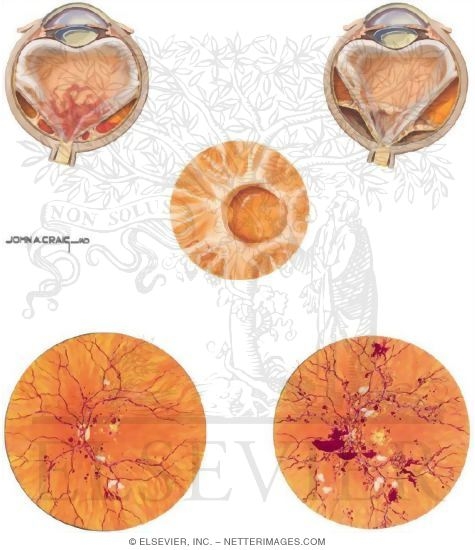 Diabetic Retinopathy