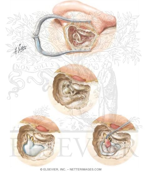 Removal of Acoustic Neuroma