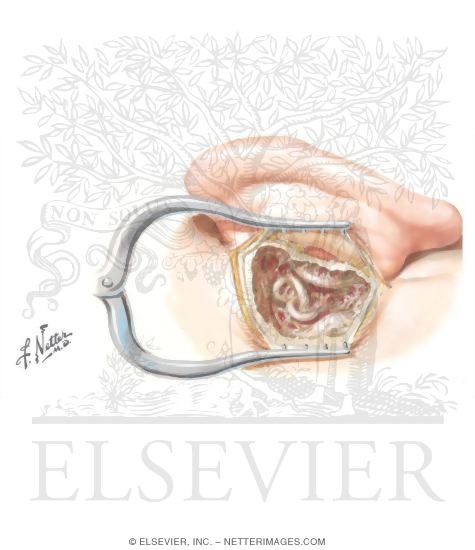 Translabyrinthine Removal of Acoustic Neuroma