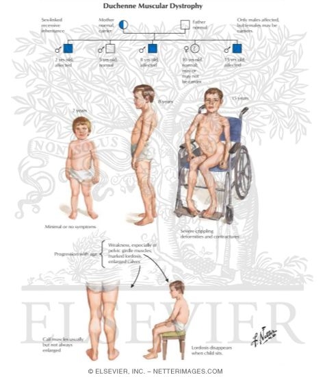Duchenne's Muscular Dystrophy
