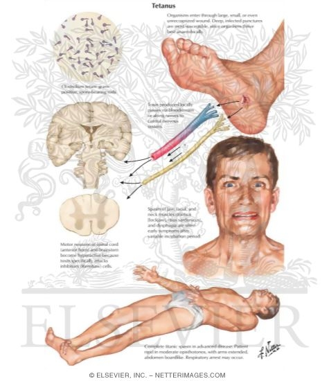 Tetanus