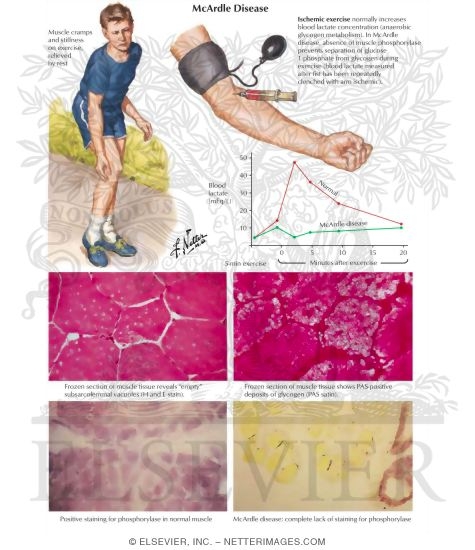 McArdle Disease