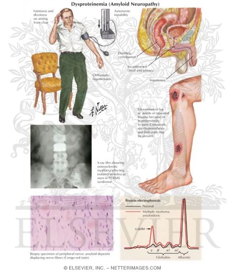 Dysproteinemia (Amyloid Neuropathy)