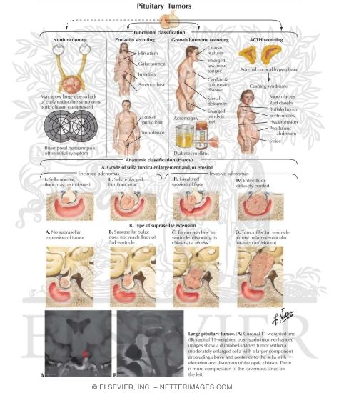 Pituitary Tumors