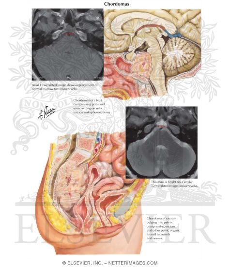 Chordomas