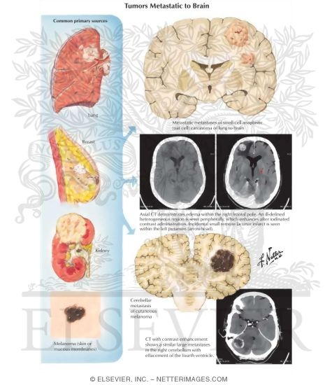 Tumors Metastatic to Brain