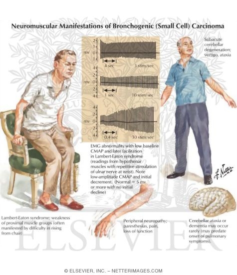 Neuromuscular Manifestations of Bronchogenic Carcinoma