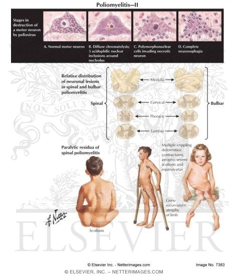 Poliomyelitis Image