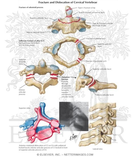 Fracture and Dislocation of Cervical Vertebrae
