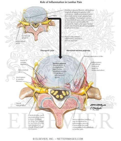 Role of Inflammation In Lumbar Pain