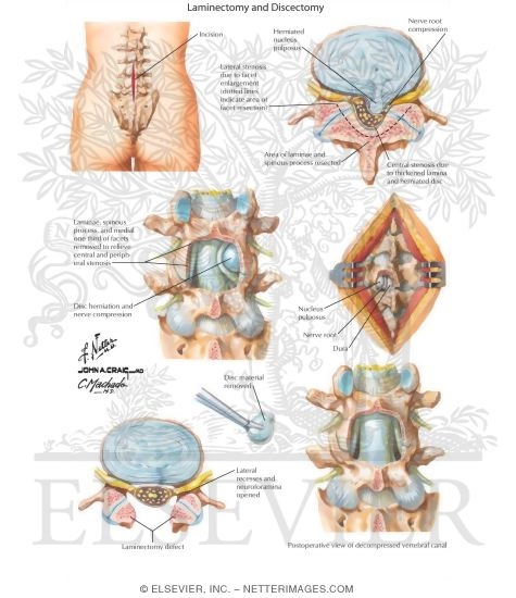 Laminectomy and Discectomy
