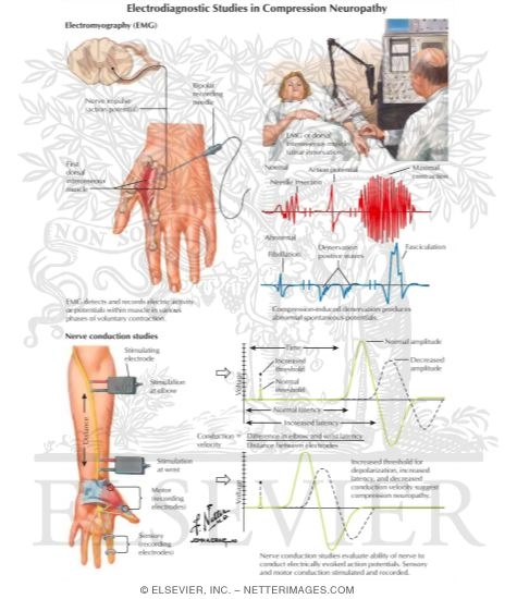 Electrodiagnostic Studies In Compression Neuropathy