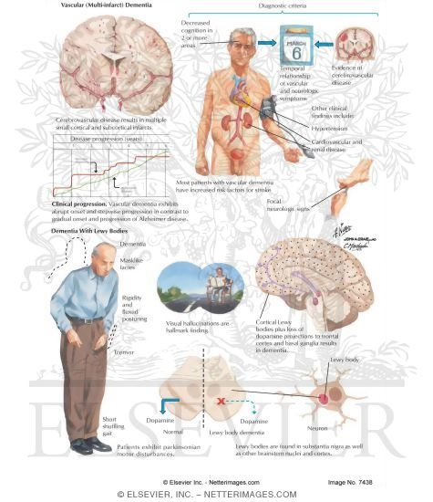 Vascular Dementia and Dementia With Lewy Bodies