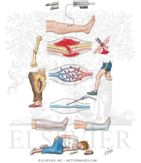 Compartment Syndrome