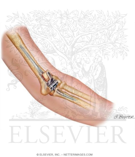 Prosthesis for Total Elbow Arthroplasty