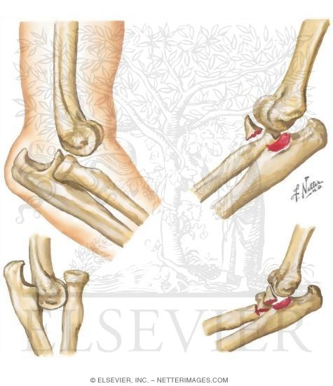 Dislocation of Elbow Joint