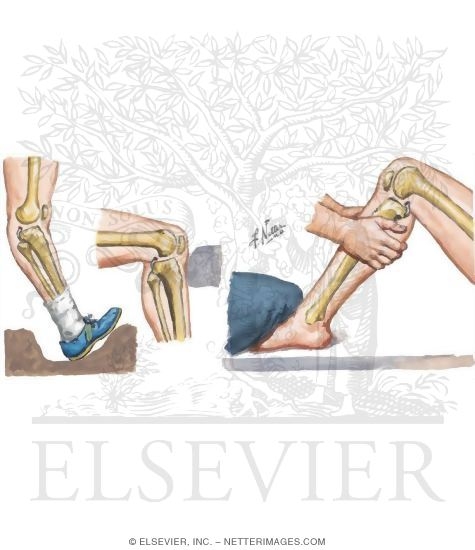 Rupture of Posterior Cruciate Ligament