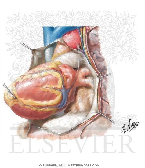 Heart Drawn Out of Pericardial Sac: Left Lateral View