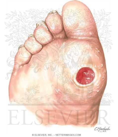 skin ulcer skin ulcer in the diabetic foot skin ulcer skin ulcer in the diabetic foot