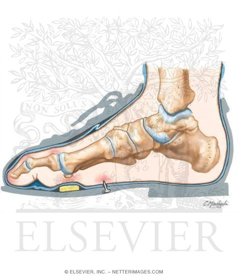 Diabetic Foot Care
