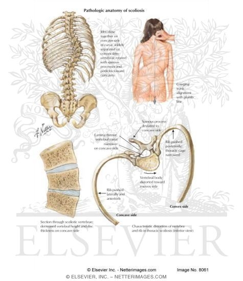 Accentuated Spinal Curvatures