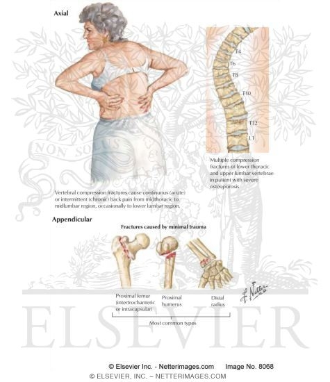 Osteoporosis