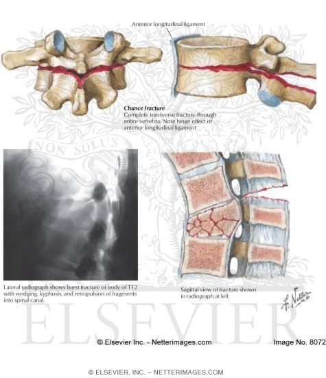 Vertebral Dislocation and Fractures