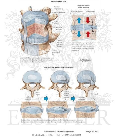 Process of Intervertebral Disc Herniation
