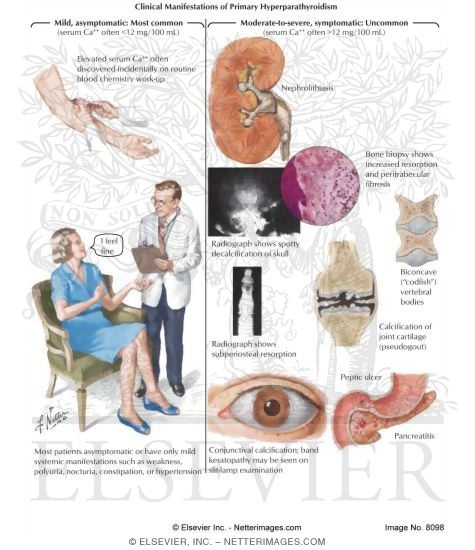 Clinical Manifestations of Primary Hyperparathyroidism