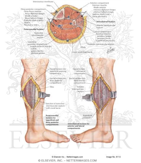Compartment Syndrome