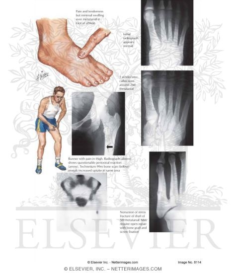 Stress Fracture