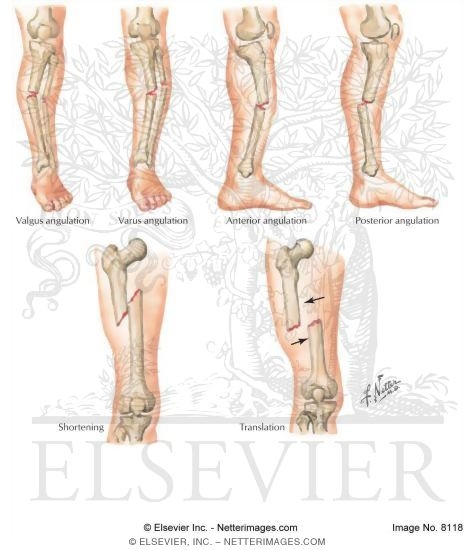 Types of Displacement