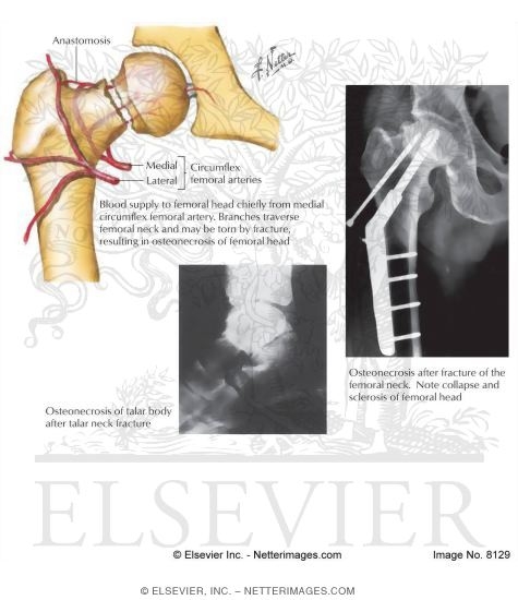 Osteonecrosis After Fracture