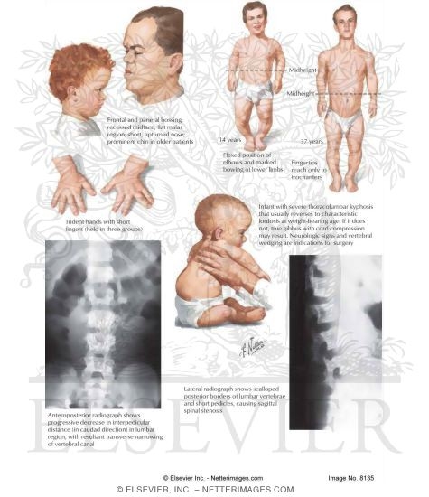 achondroplasia lessons blendspace