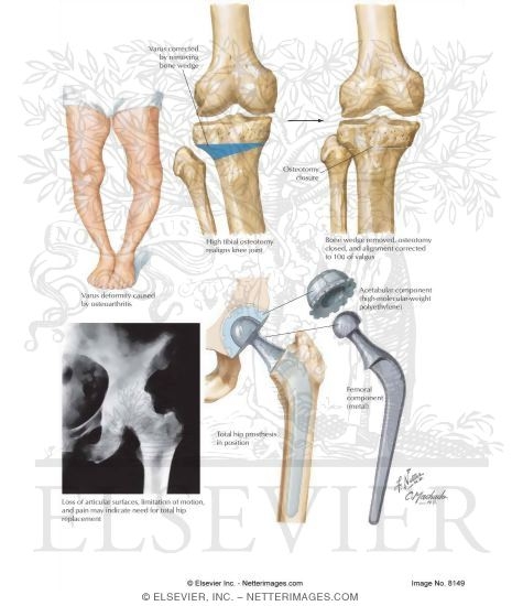 Surgical Alternatives for Osteoarthritis (OA)