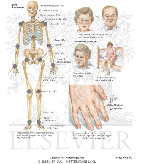 Clinical Presentation of Rheumatoid Arthritis