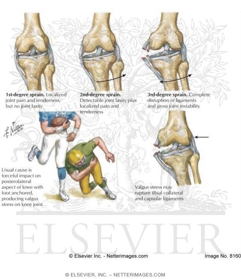Grading of Ligament Sprains