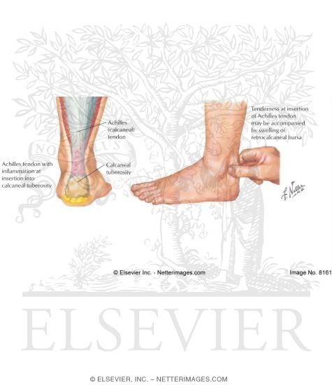 Insertional Achilles