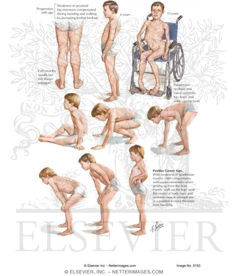Duchenne Muscular Dystropy