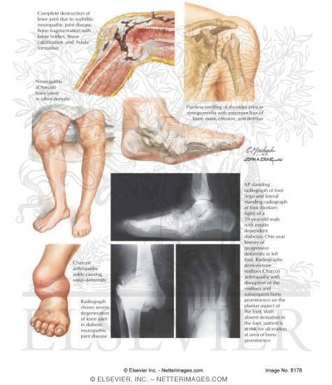 Charcot Shoulder