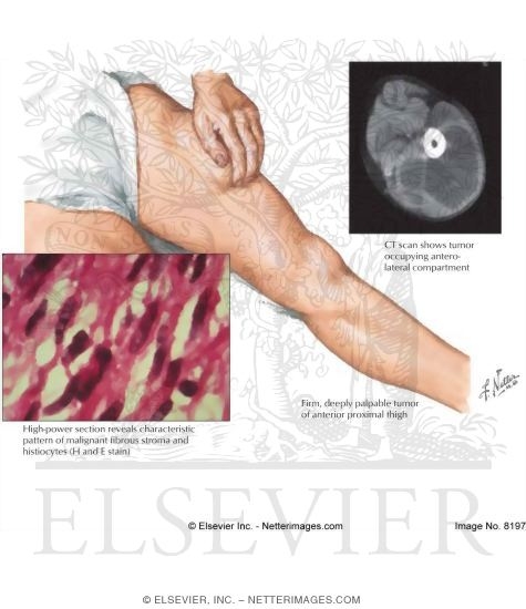 Malignant Fibrous Histiocytoma of Soft Tissue