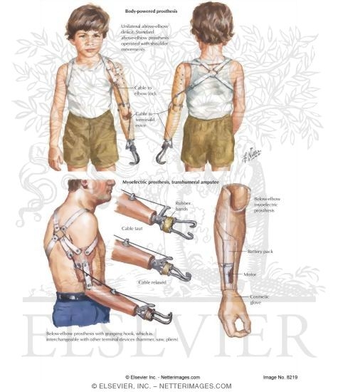 myoelectric prosthesis