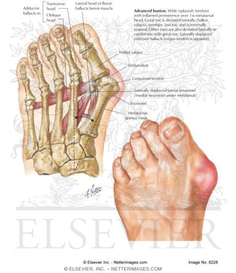 Bunion, Hallux Valgus, and Metatarsus Primus Varus