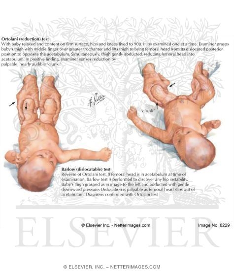 Recognition of Congenital Dislocation of the Hip