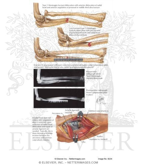 Ulna Shaft