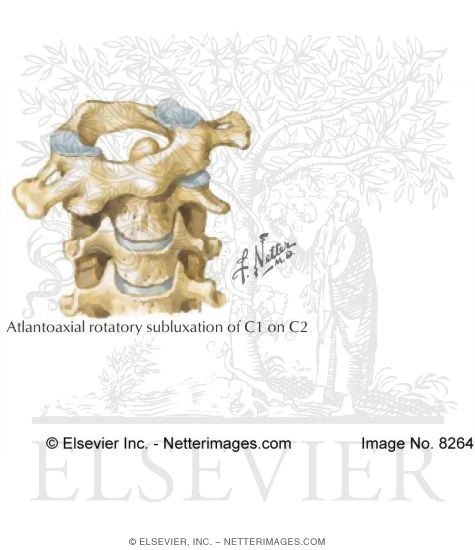 Atlantoaxial Rotatory Subluxation of C1 On C2